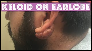 Keloid on Earlobe treated with Cryoshape - Before &amp; Afters and more Treatment