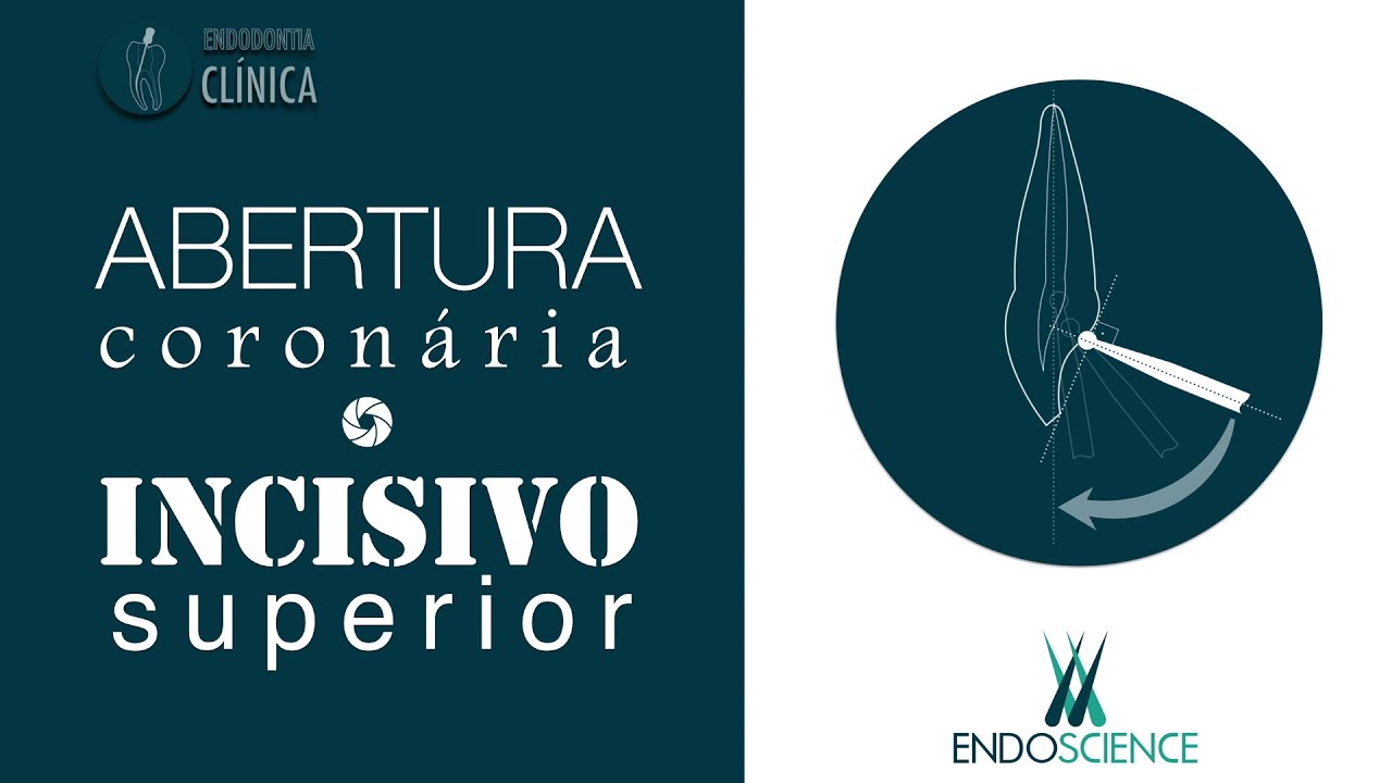 Anatomia e abertura coronária do Incisivo Superior