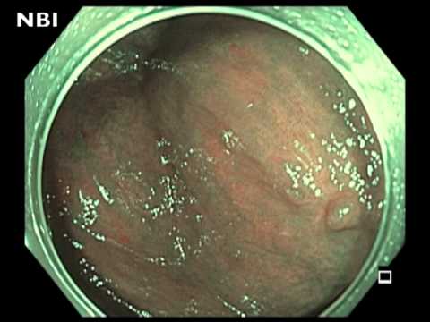 Cicatrice de la Valvule Iléo-cæcale