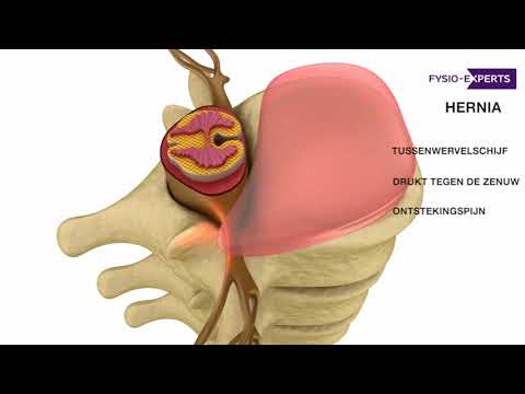 What is a herniated disc (HNP)?