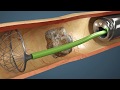 Como é Feita A Cirurgia De Pedra Nos Rins Vídeo Da Cirurgia Em 3D