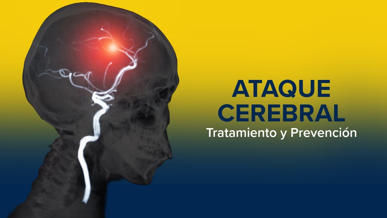 Thumbnail preview of Tratamiento y prevención de un ataque cerebral (ictus) | UC Davis Health