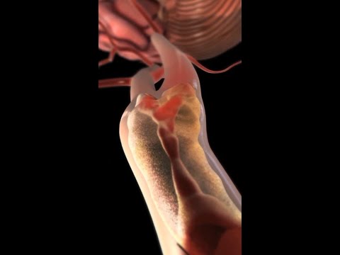 Carotid Arteries Under Attack: How Plaque Leads to Stroke #medicine #anatomy #shorts