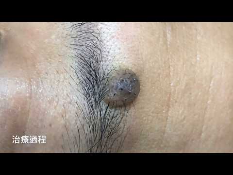 大顆痣