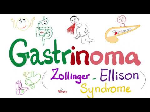 Gastrinoma (Zollinger-Ellison Syndrome or ZES) - Endocrinology and Pathology