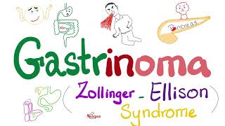 Zollinger-Ellison Syndrome (ZES) - Gastrinoma - Neuroendocrine Tumors - Endocrinology and Pathology
