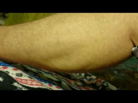 Faszikulation - Muskelzittern - Muskelzucken - Wadenzittern - Wadenkrämpfe - Myalgie ? Der Holgi