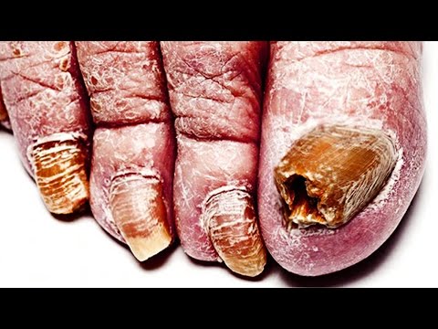 Ang ilang mga pamahid laban sa fungi sa kamay Biogel nail treatment