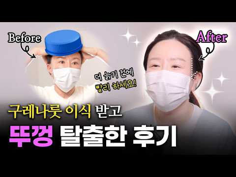 Why Sideburns Are Important to Women | Late Hair Transplant | Mogherim Plastic Surgery