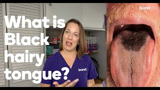 What is a black hairy tongue?