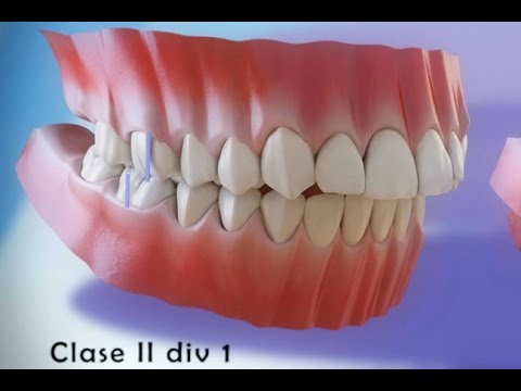 سوء الإطباق – أنواع سوء إطباق الأسنان ©