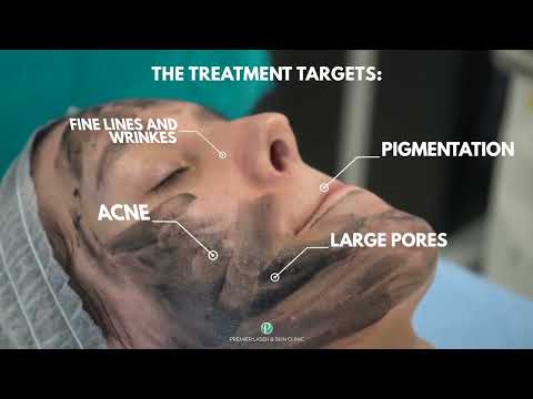 EVERYTHING YOU NEED TO KNOW ABOUT CARBON SPECTRA PEEL (HOLLYWOOD PEEL)