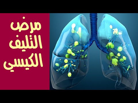 مرض التليف الكيسي .. أسبابه وأعراضه ومضاعفاته