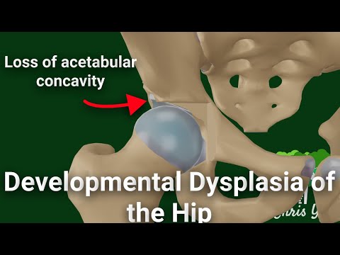 Pathology of Developmental Dysplasia of the Hip (DDH) (Animated)
