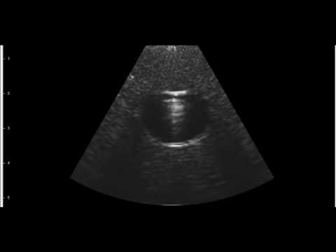 Short and Long Axis Needle Track VA Probe