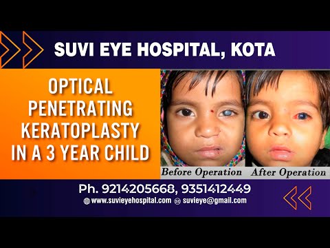 Optical Penetrating Keratoplasty In A Child