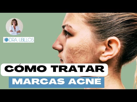 CÓMO TRATAR MARCAS ACNÉ