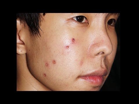โรคสะเก็ดเงินในมือ ไม่ครีมหลุมสำหรับโรคสะเก็ดเงิน