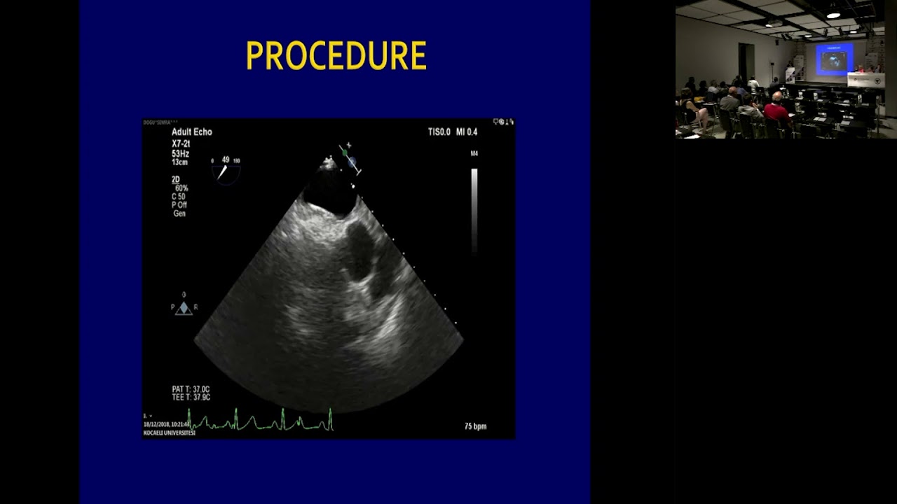 A Different Approach For A Different Type of Patent Foramen Ovale — Olgu