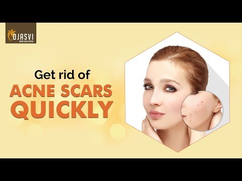 What are Acne Scars | How to Get Rid of Acne Scars Quickly | Ojasvi Skin Solutions