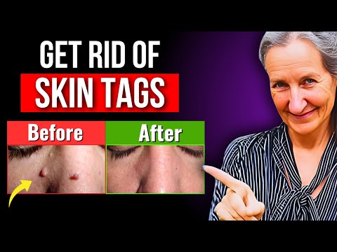 9 Effective Ways to Remove Skin Tags at Home - Here’s How! | Barbara O'Neill