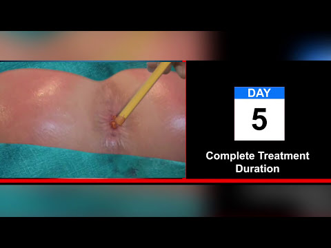 Piles Treatment || How To Prepare & Apply Anti Piles Medicine | Contact: +919522195222