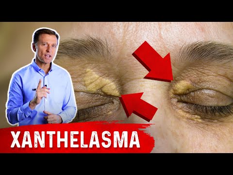 Which Vitamin Deficiency Causes Chapped Cracked Lips – Dr Berg