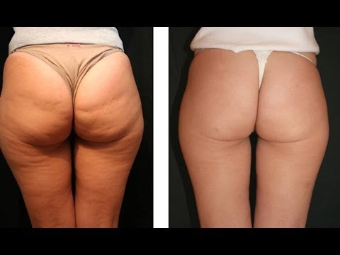 comment traiter cellulite cuisses