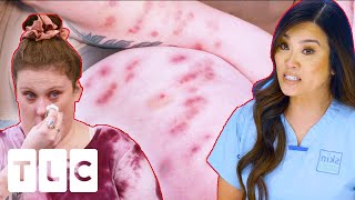 Dr Lee Solves The Mystery Behind The Sores All Over A Patient’s Body | Dr Pimple Popper: This Is Zit