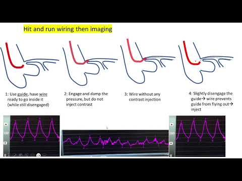 Damping and ventricularization + how to handle