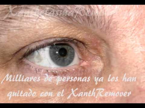 Xantelasma, como quitar los Xantelasma en Casa!
