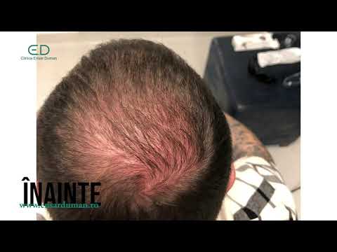 Ensar Duman - Mihai Zaharia - implant de păr și tratament cu laser pentru păr la Clinica Ensar Duman