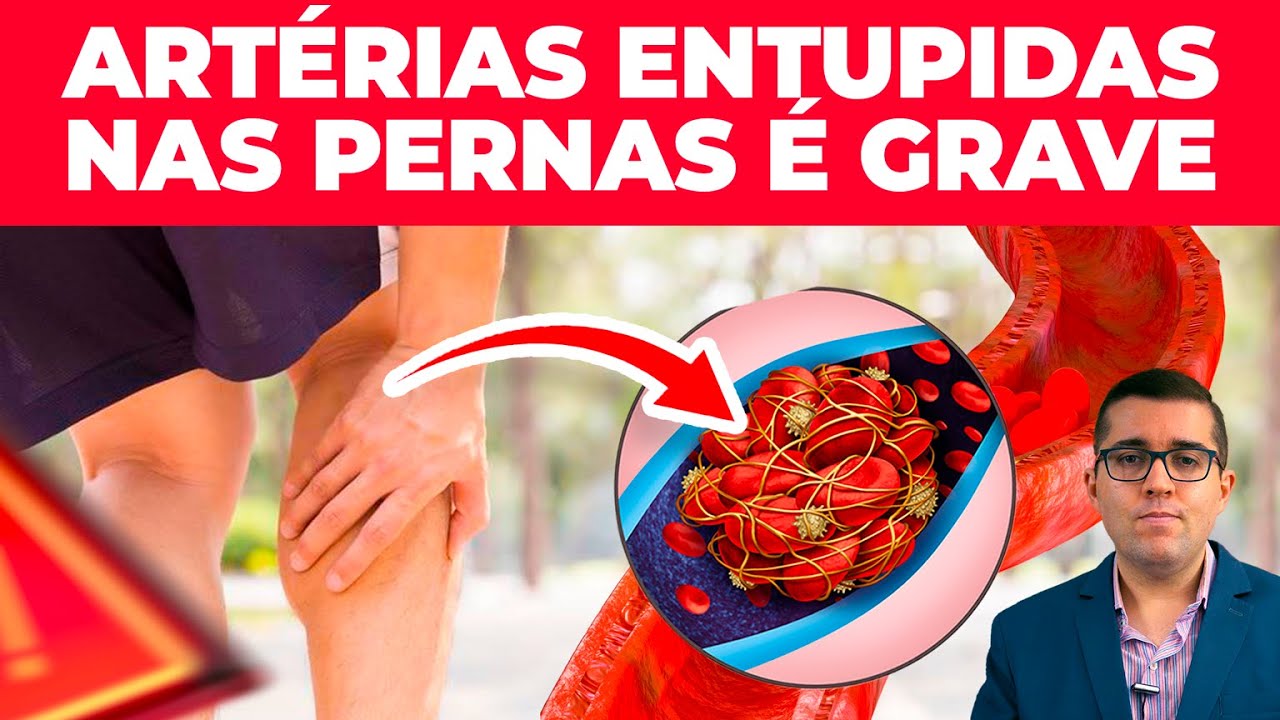 Riscos das artérias entupidas: trombose que não incha as pernas, alerta de alto índice de amputação!
