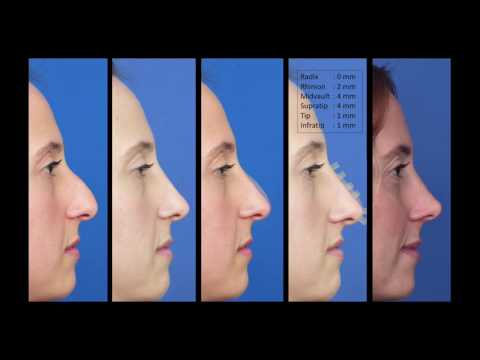 download lagu mp3 mp4 Plastic Surgery Photoshop, download lagu Plastic Surgery Photoshop gratis, unduh video klip Plastic Surgery Photoshop
