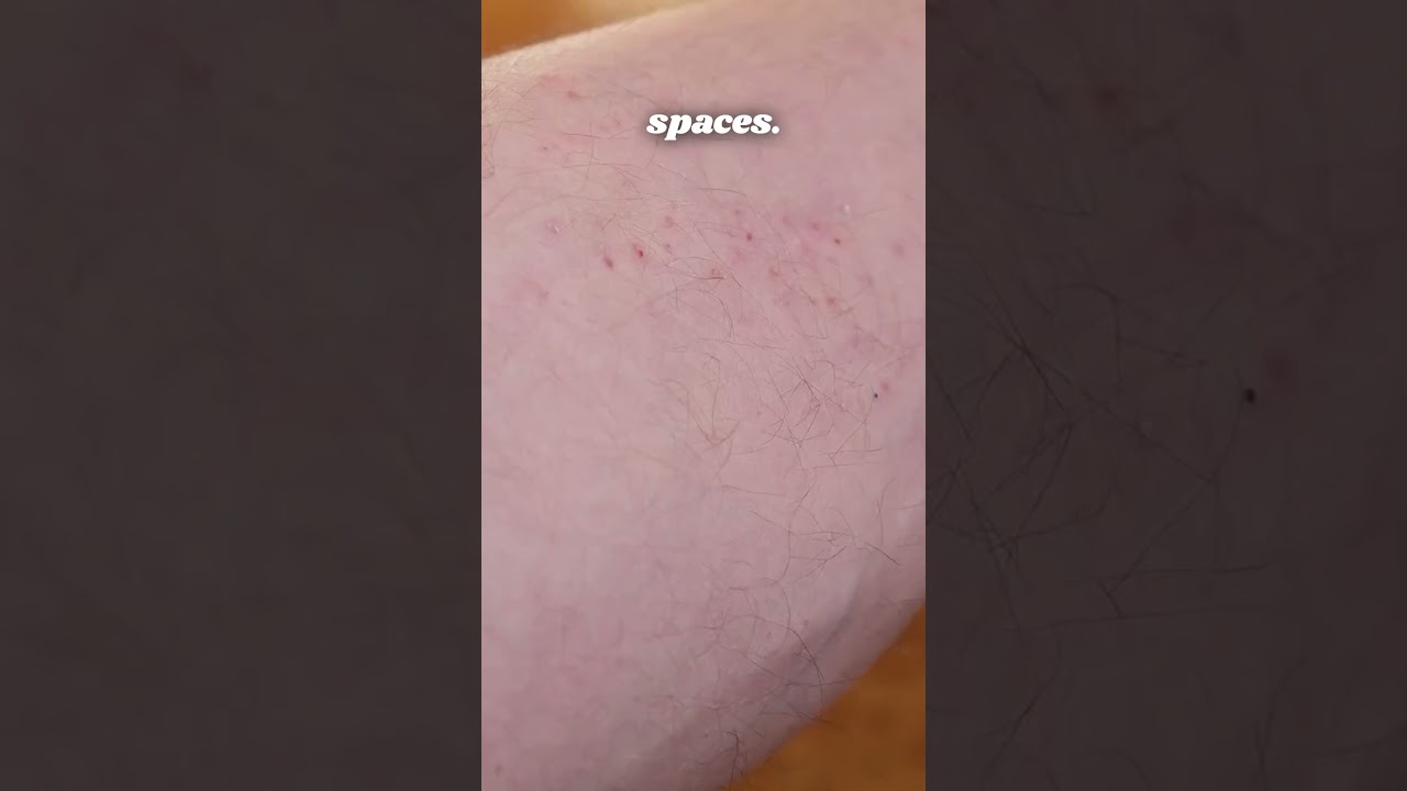 Measles Alert #healthtips #measles #healthyvideos #fitness #medicalcentric