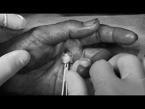 MỔ HỘI CHỨNG NGÓN TAY BẬT