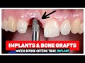 Dental Implants Bone Grafting After Tooth Extractions