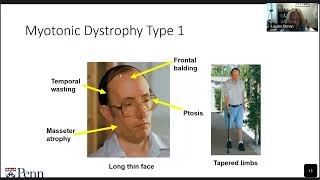 Updates in research and treatments in Myotonic Dystrophy