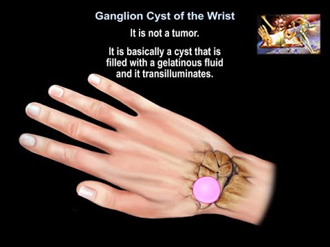 Ganglion Cyst Of The Wrist - Everything You Need To Know 