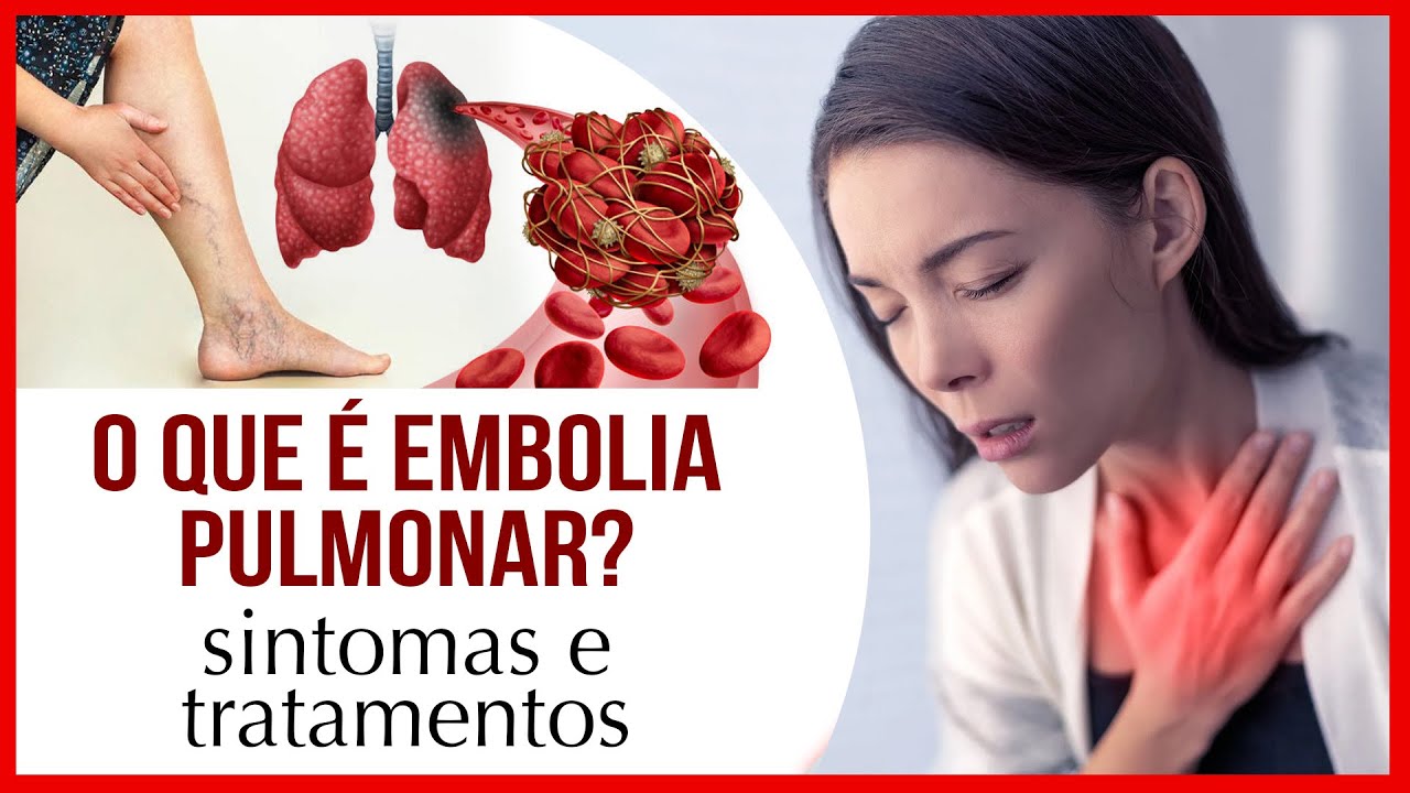 O que é Embolia Pulmonar? Sintomas e Tratamentos.