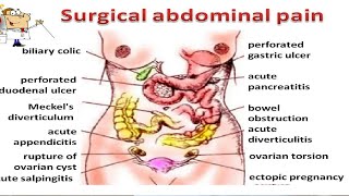 The Ultimate Guide to Dealing with Acute Abdominal Pain!