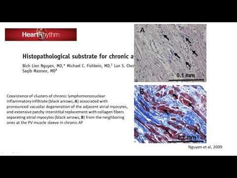 Pathophysiology, risk factors and prevention of atrial fibrillation   Dr  Omar Riad, MSc, MRCPUK