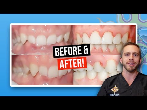 Severe Deep Bite: BEFORE AND AFTER BRACES