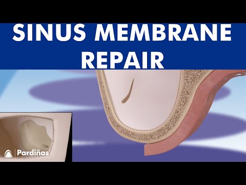 Sinus membrane perforation repair ©