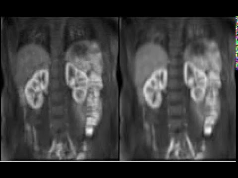 Movement correction in DCE-MRI
