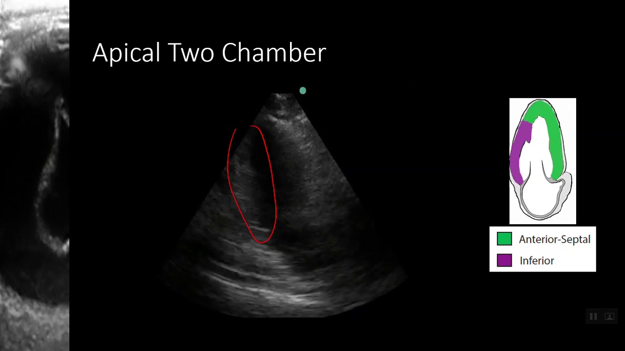 Point-of-Care Echo: Regional Wall Motion Abnormalities