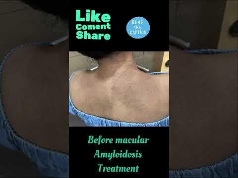 Macular Amyloidosis treatment | LPP| Skincare |Dermatologist in Punjab | Dr Ashima Goel| PARISA