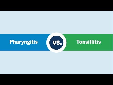 Pharyngitis vs. Tonsillitis
