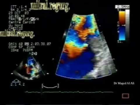 LV Localized Hypertrophy, Flail Anterior Leaflet With Severe Mitral Regurgitation