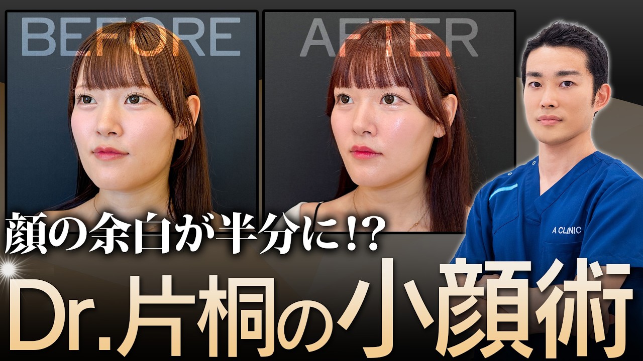 【1day小顔】ダイエットしても顔だけ痩せない私が受けてみた